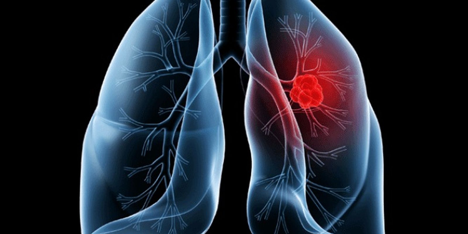 Saiba o que é adenocarcinoma pulmonar, câncer que atinge o papa